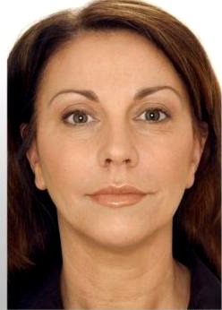 Mieke HIFU Face Lifting result — after