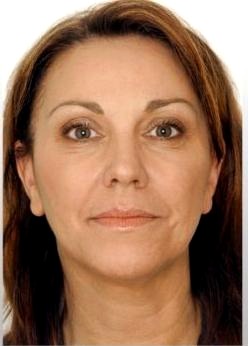 Mieke HIFU Face Lifting result — before