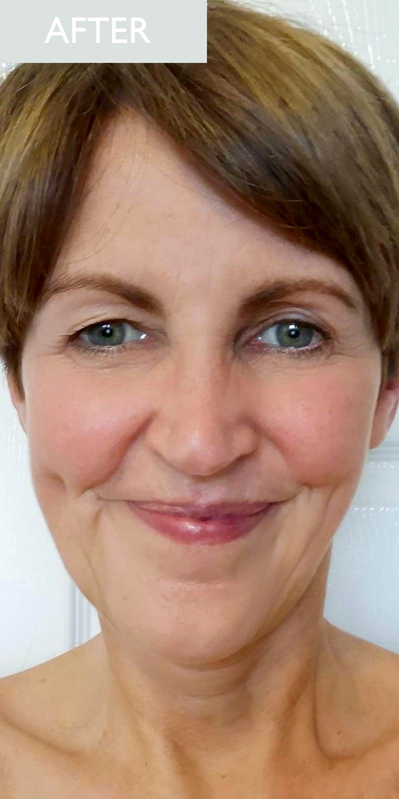 Anri V. RF Skin Tightening result — after