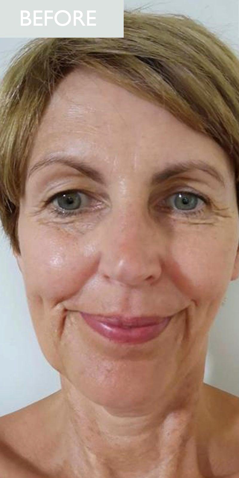 Anri V. RF Skin Tightening result — before