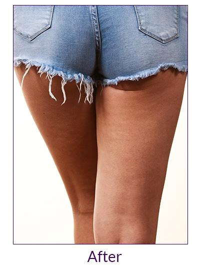 Liezel B. Cryolipolysis (Fat Freeze) result — after