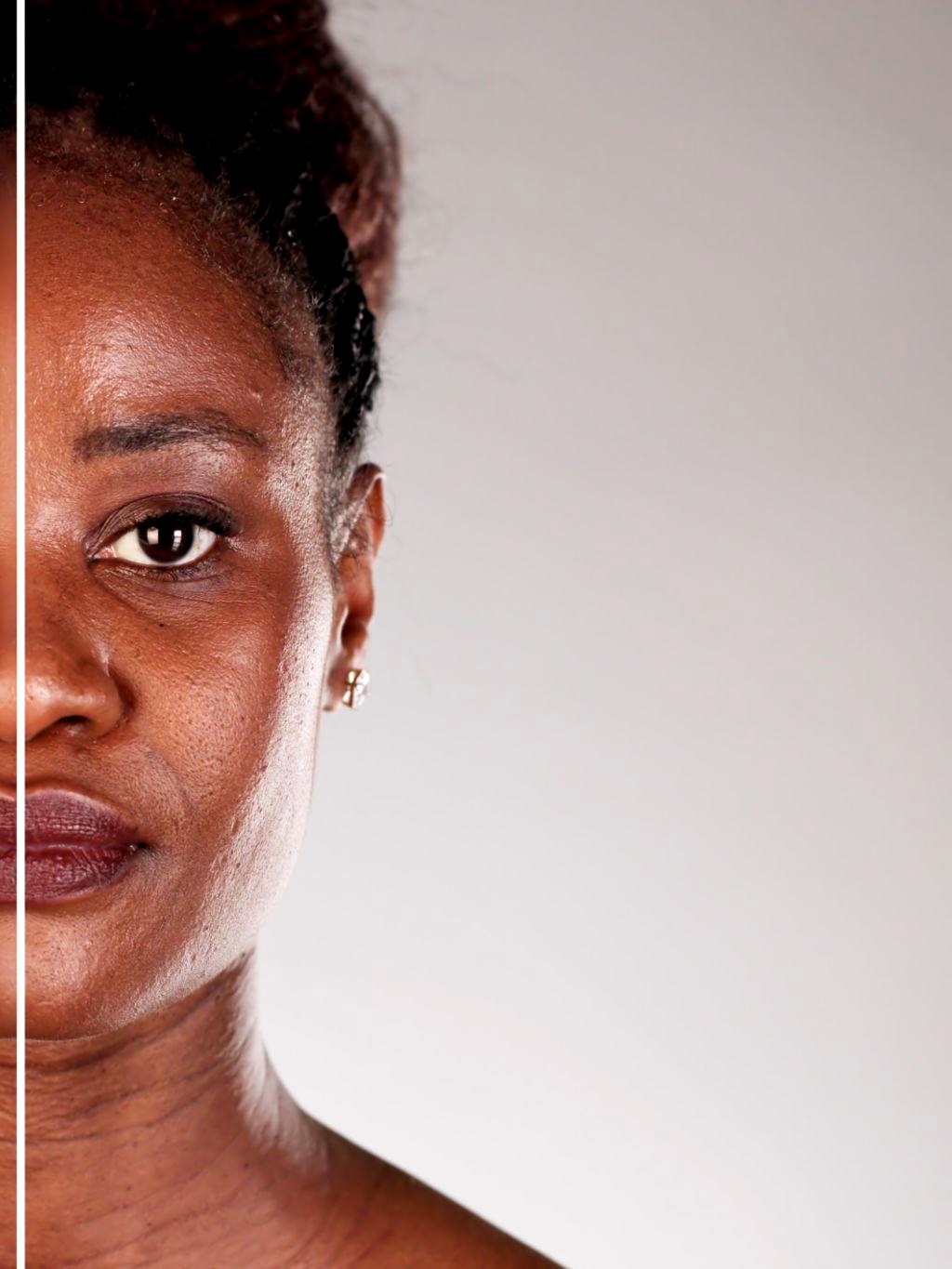 Nompumelelo D. LED Skin Rejuvenation result — before