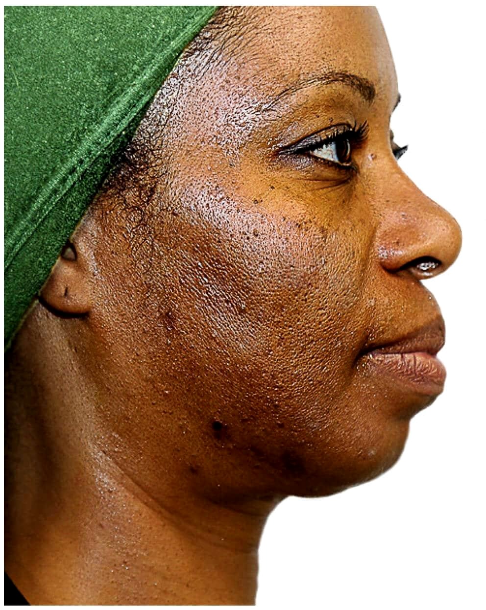 Zanele P. RF Skin Tightening result — before