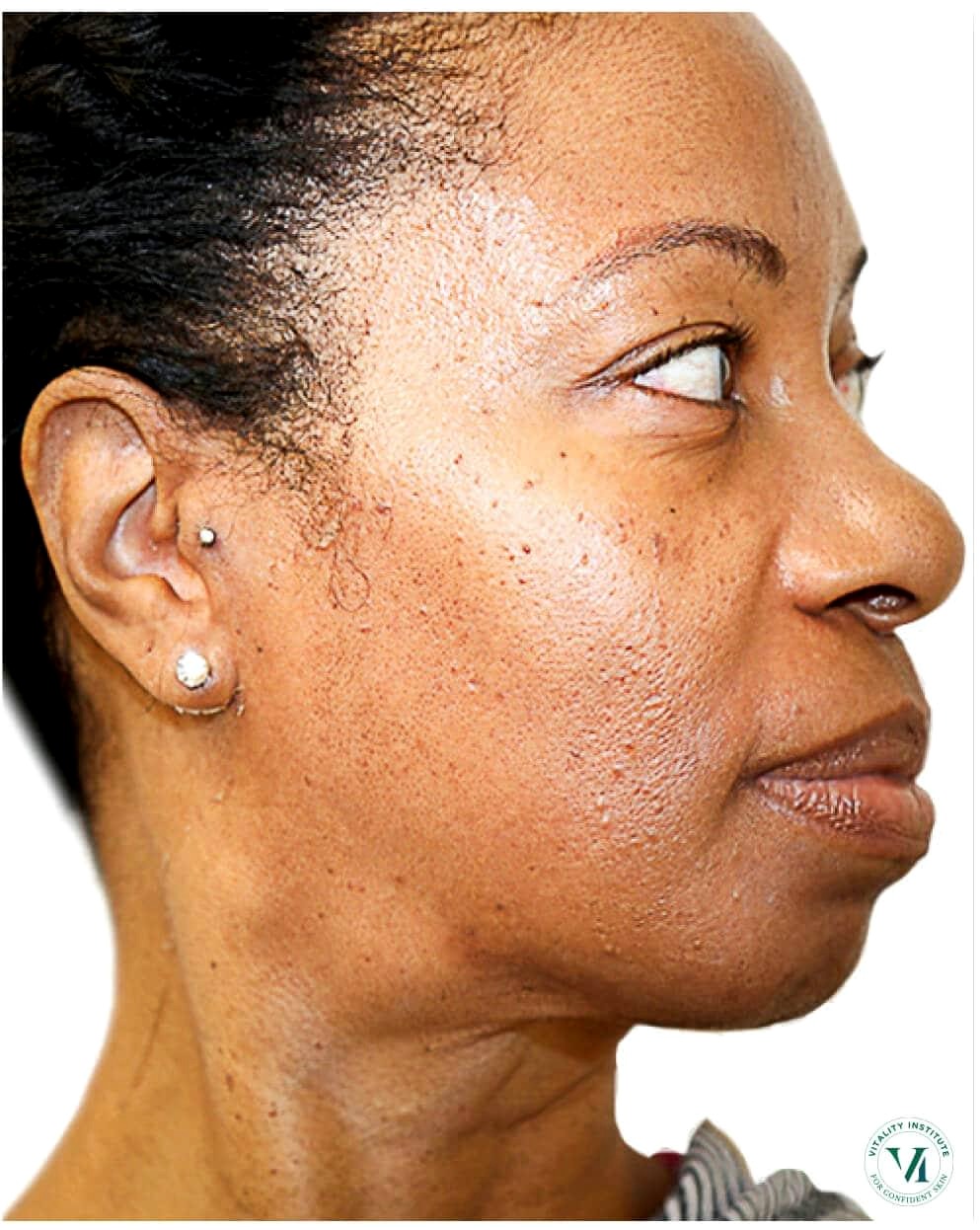 Zanele P. RF Skin Tightening result — after